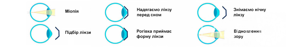 Нічна корекція зору