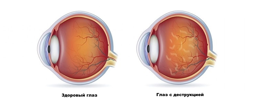 деструкция Лечение ДСТ глаза с помощью витреолизиса