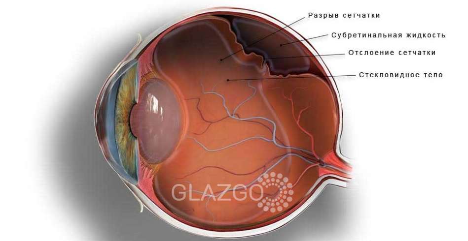 оперативное лечение отслойки сетчатки