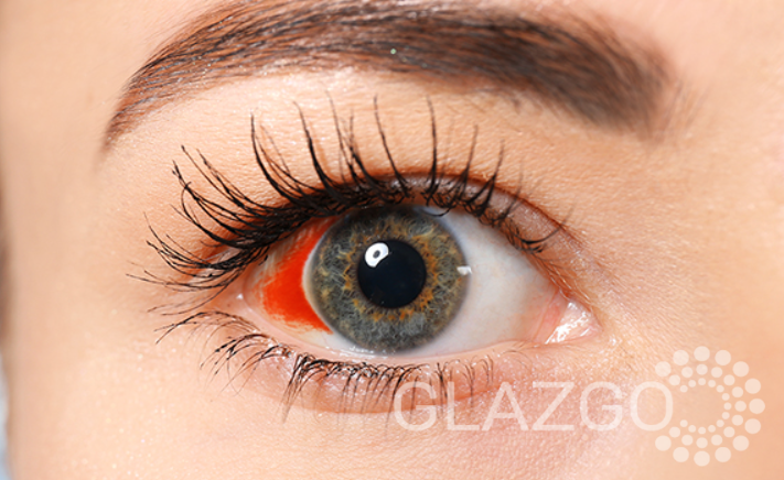 Гемофтальм лечение Кровоизлияния в стекловидное тело лечение