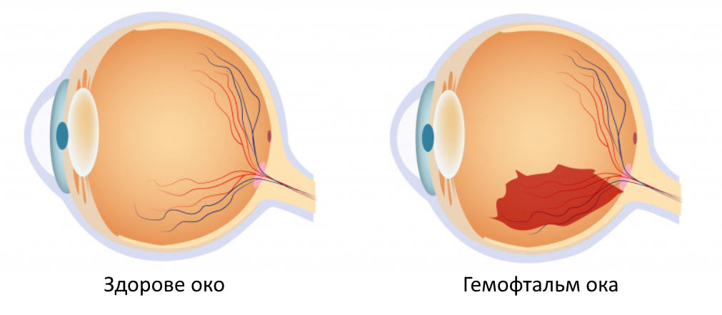 Гемофтальм ока Гемофтальм глаза