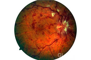 Тромбоз центральной вены сетчатки