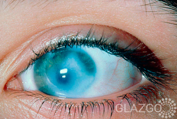 Дистрофия-сетчатки-глаз