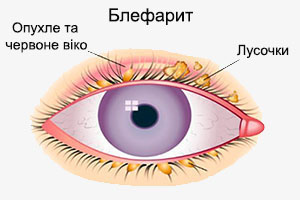 Блефарит - лікування захворювання