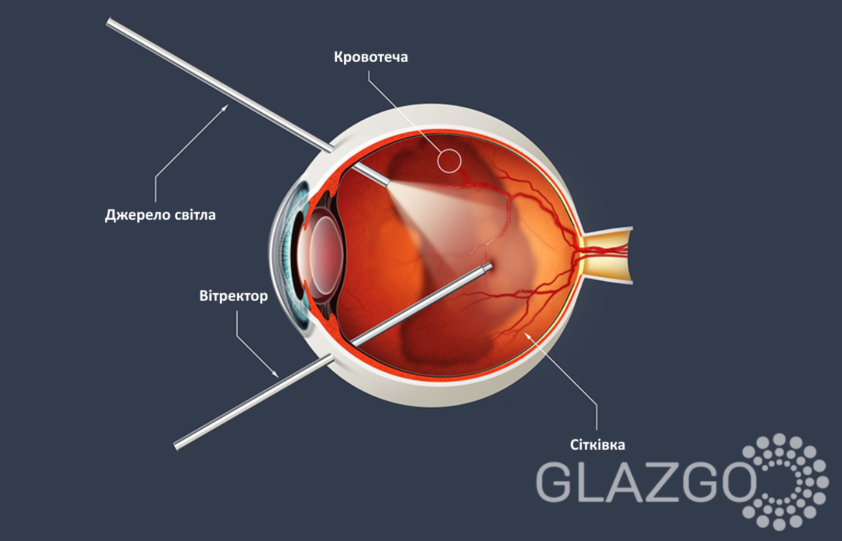 Screenshot_2 витрэктомия